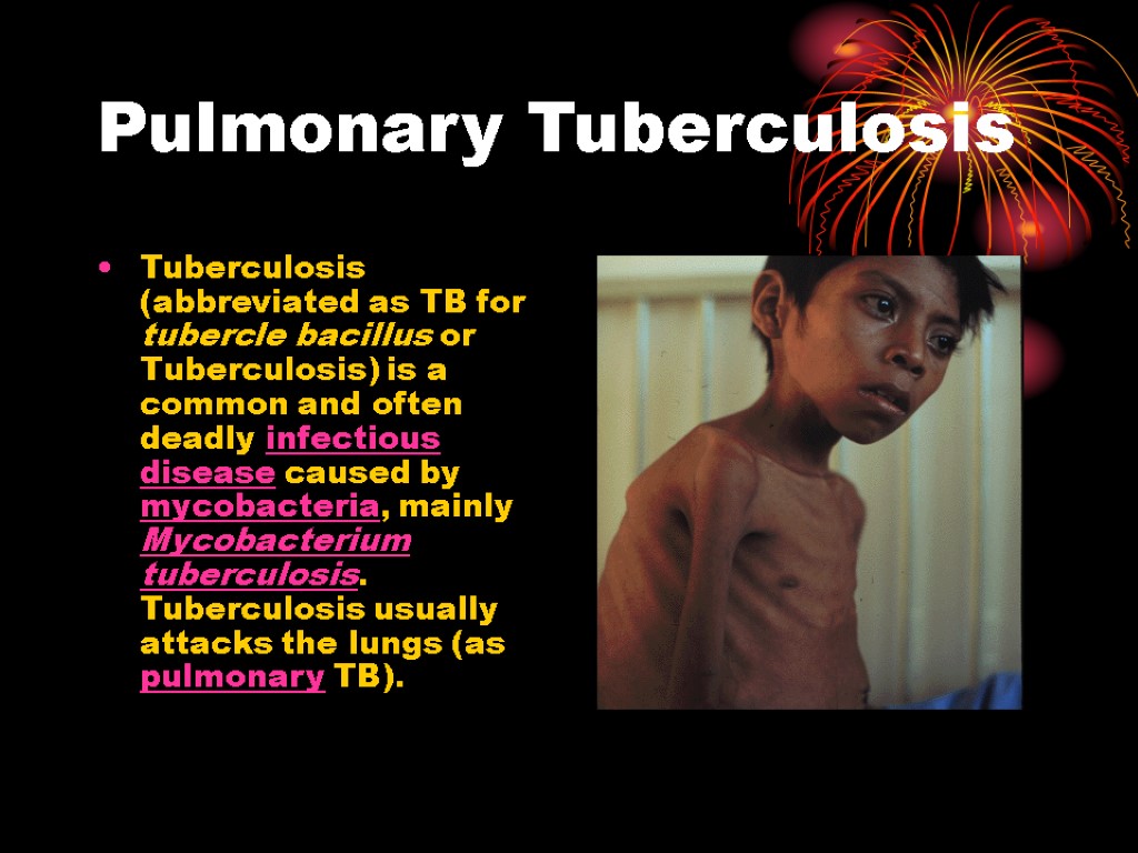 Pulmonary Tuberculosis Tuberculosis (abbreviated as TB for tubercle bacillus or Tuberculosis) is a common